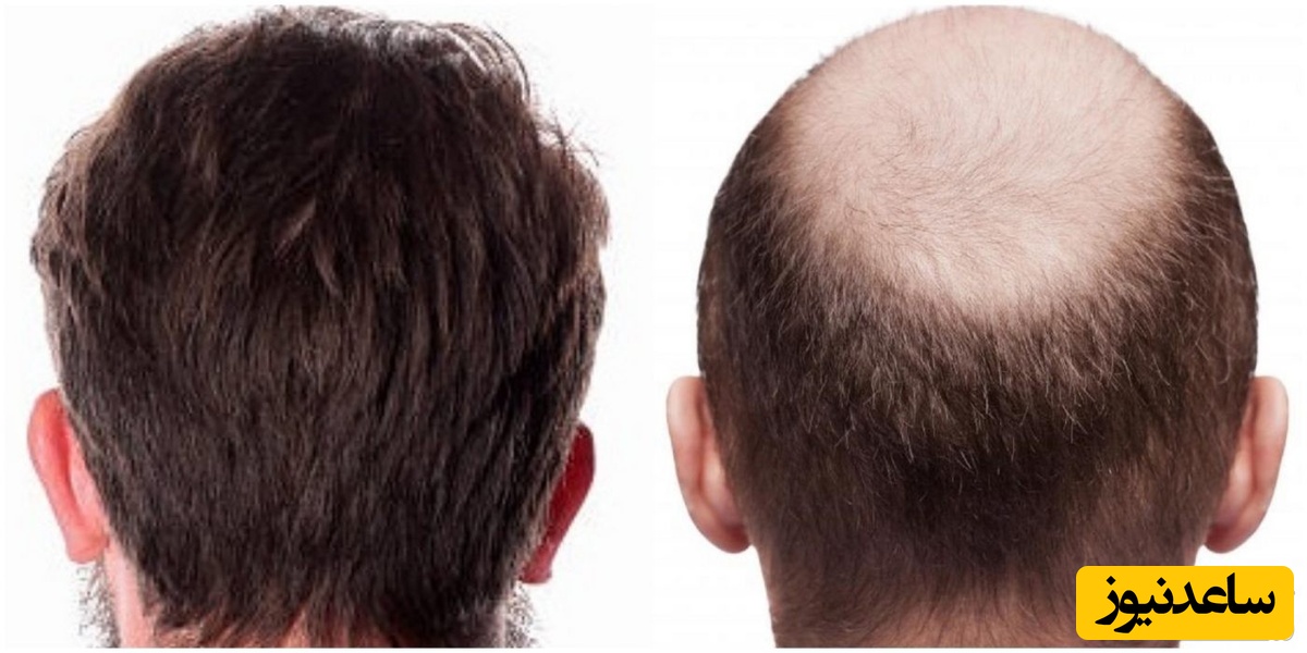 سن مناسب برای کاشت مو چه زمانی است؟