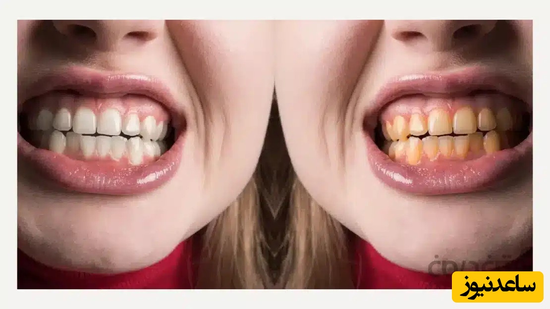 سفیدی دندان های زرد در عرض 10 دقیقه
