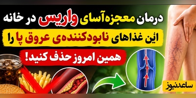 (ویدئو) درمان معجزه‌آسای واریس در خانه؛ این غذاهای نابودکننده‌ی عروق پا را همین امروز حذف کنید!