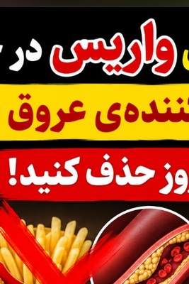 (ویدئو) درمان معجزه‌آسای واریس در خانه؛ این غذاهای نابودکننده‌ی عروق پا را همین امروز حذف کنید!