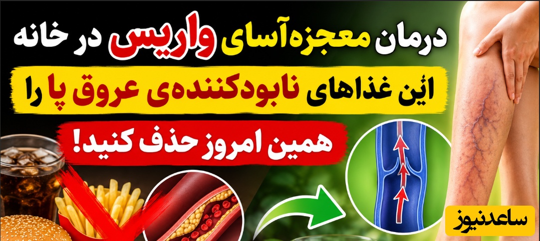 (ویدئو) درمان معجزه‌آسای واریس در خانه؛ این غذاهای نابودکننده‌ی عروق پا را همین امروز حذف کنید!