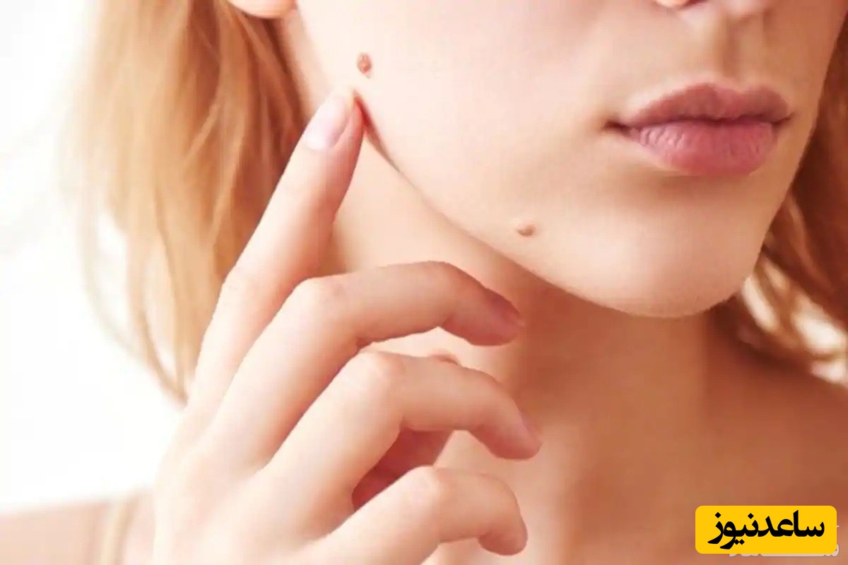 برداشتن خال به روش های مختلف چه عوارضی برای پوست دارد؟