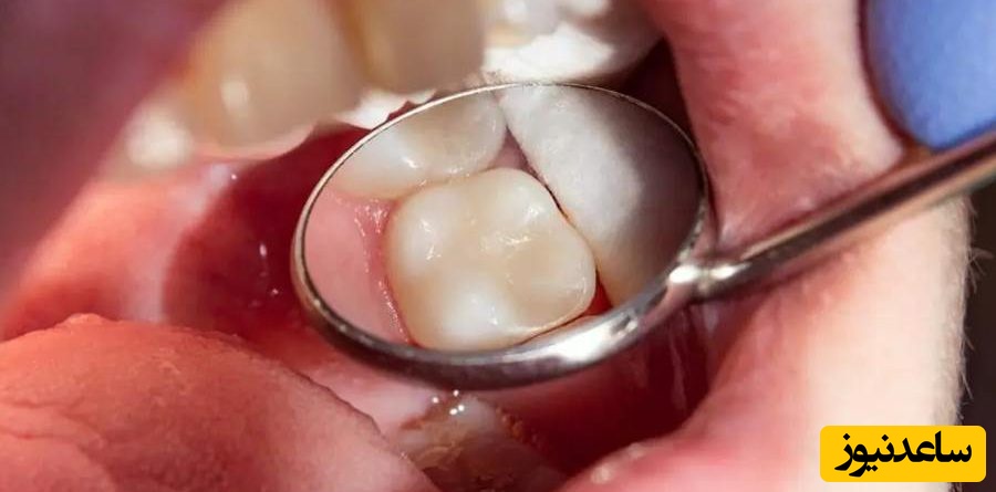 ترکیبات آمالگام در پر کردن دندان چیست؟