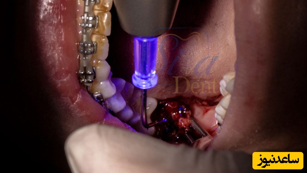 کاربرد لیزر در دندانپزشکی چیست؟