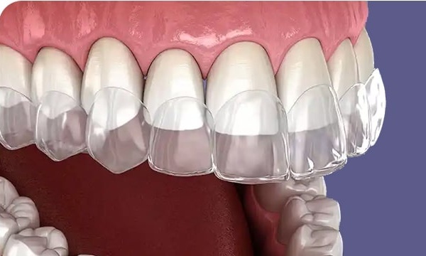 درمانی ارتونسی نامرئی چگونه است ؟ 