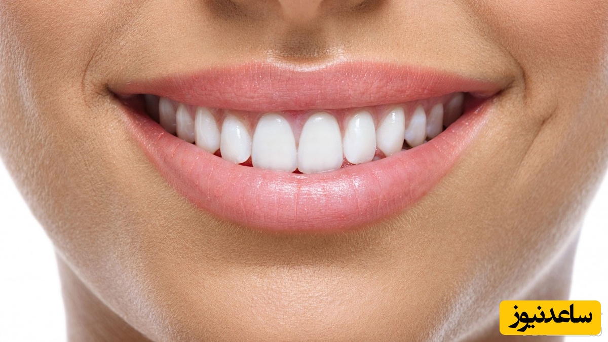 کامپوزیت برای درمان دندان کج
