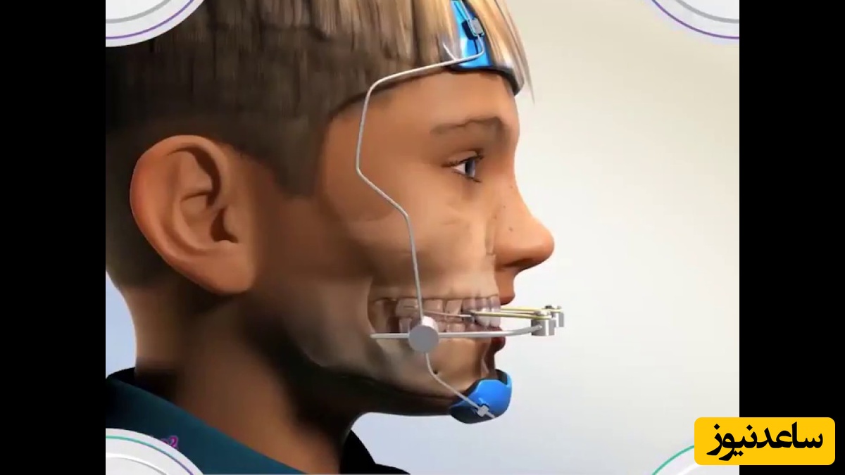 مراحل و مراقبت‌های درمان با فیس ماسک ارتودنسی