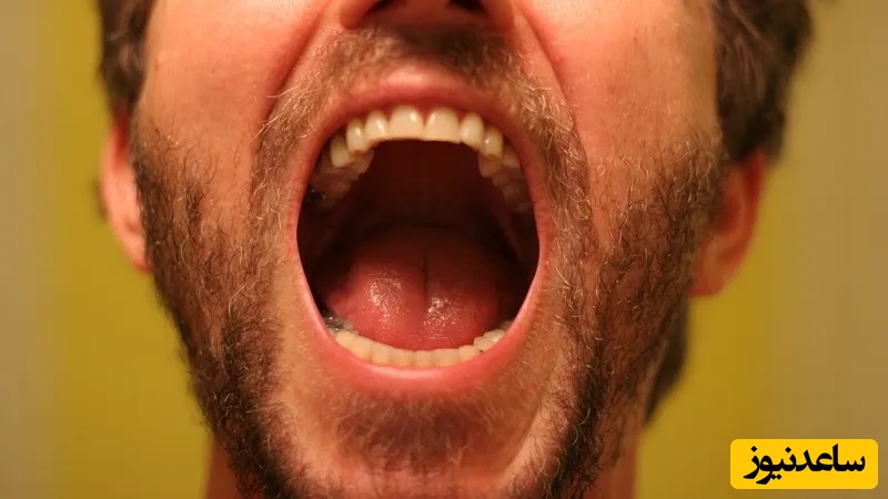 علل تورم سقف دهان کدام است ؟
