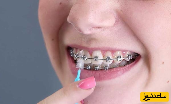 رعایت نکات مهم در مسواک زدن دندان های ارتودنسی شده