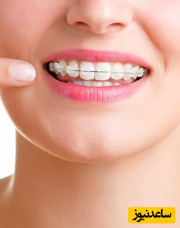 بدون وجود هر گونه سیم روی دندان ها می توان آنها را مرتب نمود!