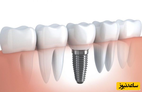 عوارض ایمپلنت برای لثه چیست؟