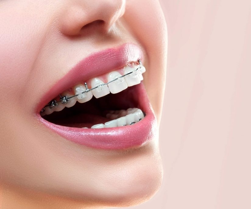 در مورد ارتودنسی سرامیکی با براکت شفاف چه میدانید؟