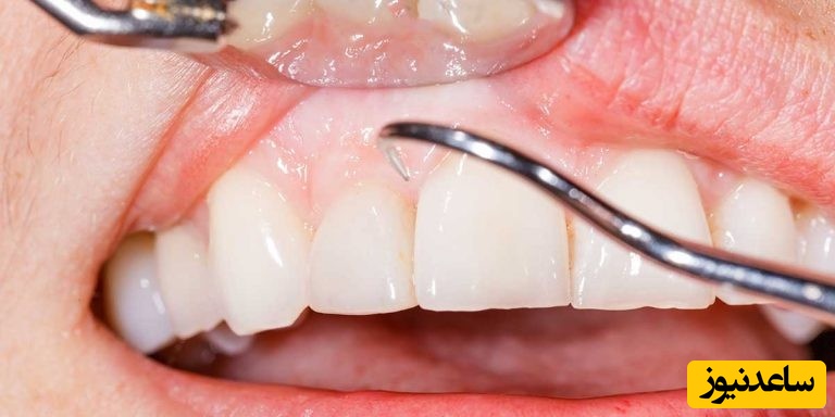 درمان ورم لثه چیست؟