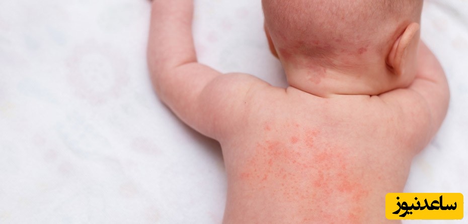 روش های تسکین و درمان عرق سوز (بثورات گرمایی) در کودک