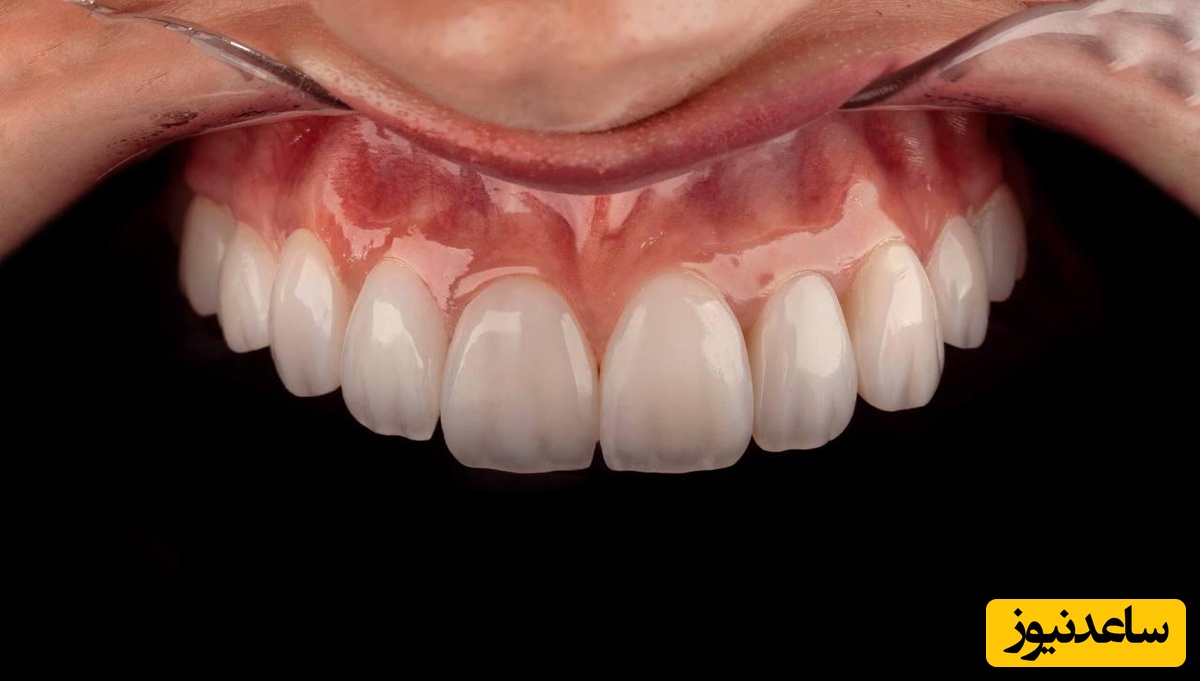 لمینت های سرامیکی چگونه موجب زیبایی لبخند می شود؟