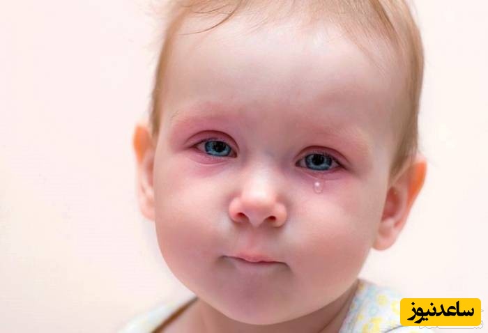 علائم بیماری چشم صورتی در کودکان و روش‌های درمان آن چیست؟