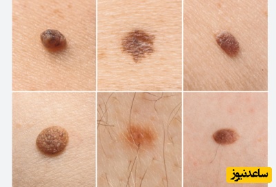 علایم سرطان پوست