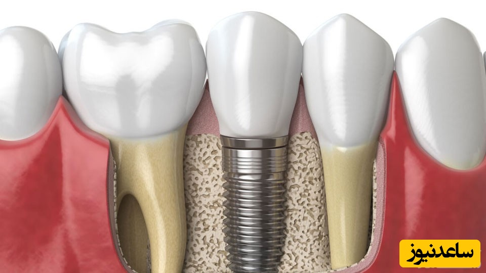 پیوند استخوان در ایمپلنت دندان