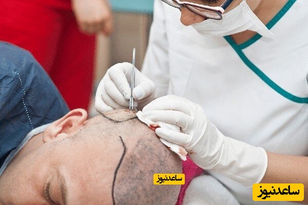 تکنسین کاشت مو