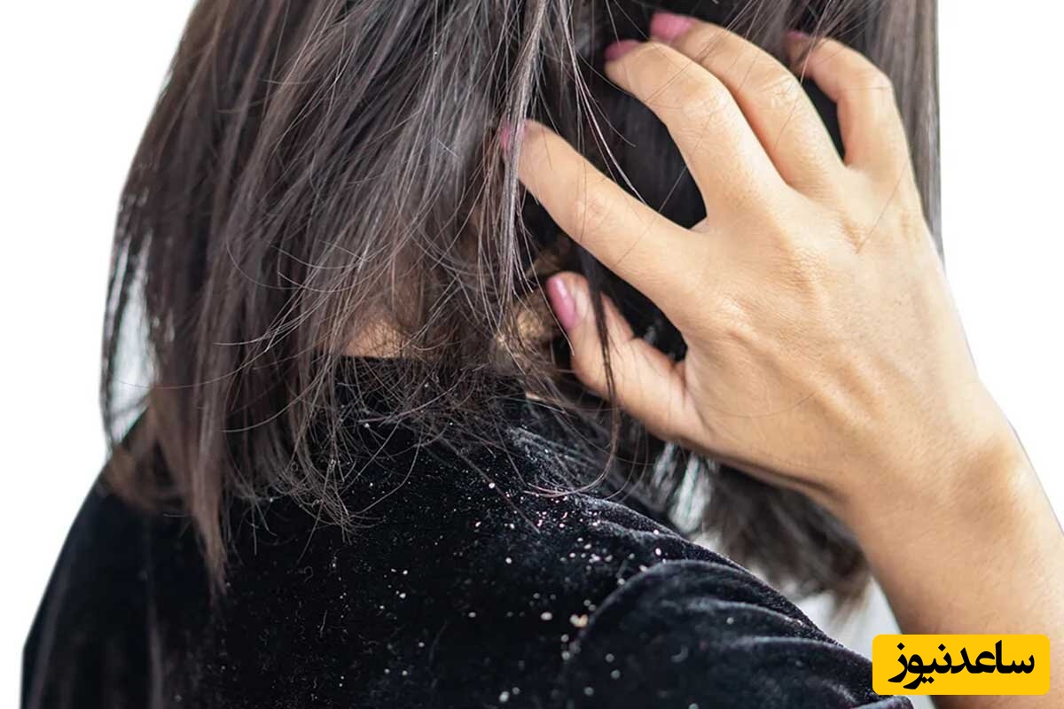 درمان سریع شوره سر تنها با چند راهکار ساده که باید یاد بگیرید
