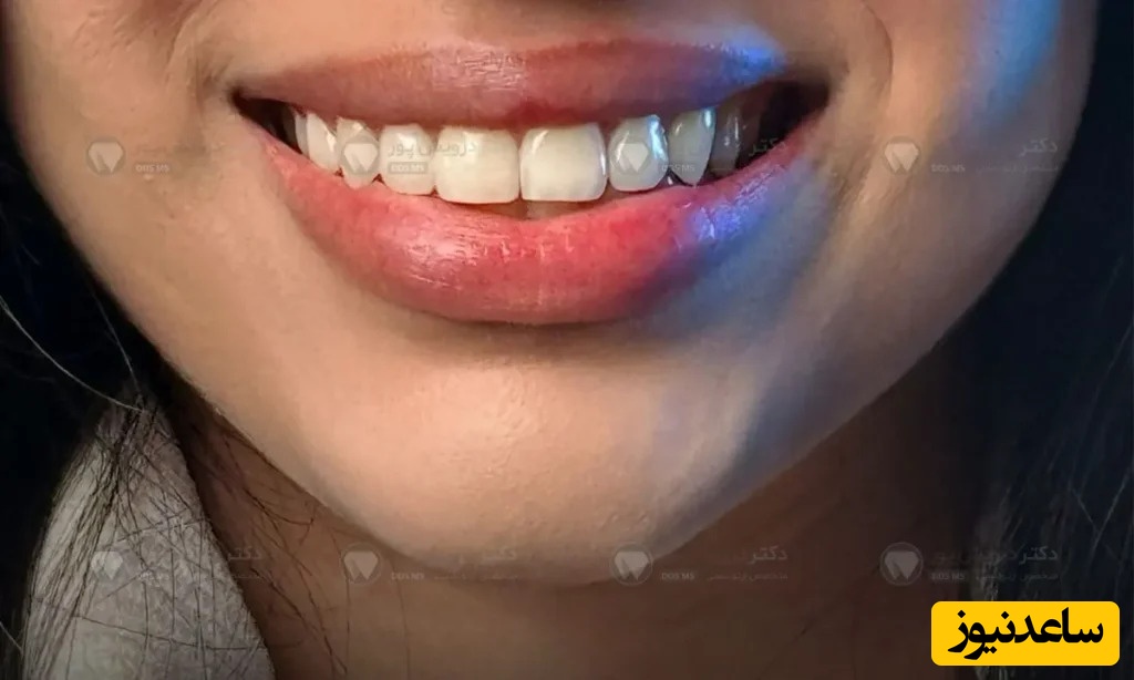 انواع ارتودنسی نامرئی