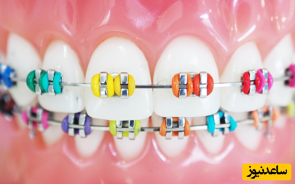 ارتودنسی رنگی چیست؟