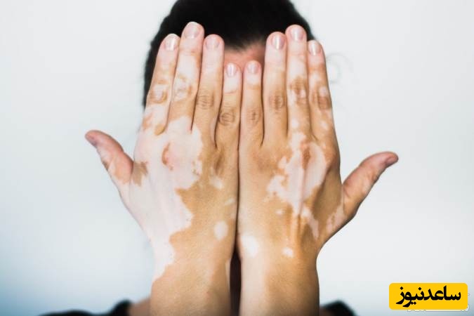 دیدن پیسی (لک شدن) در خواب چه تعبیری دارد؟ /  تعبیر خواب پیسی