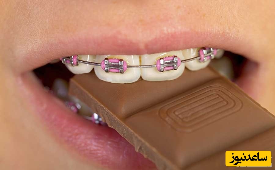 آموزش غذا خوردن با ارتودنسی