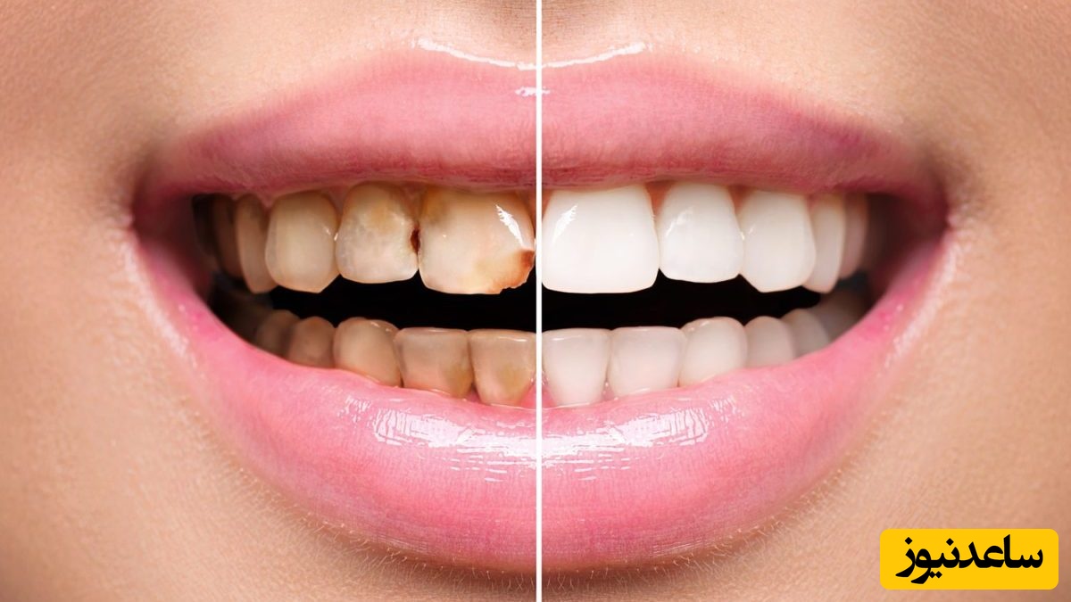 آیا کامپوزیت دندان ها را خراب می کند؟