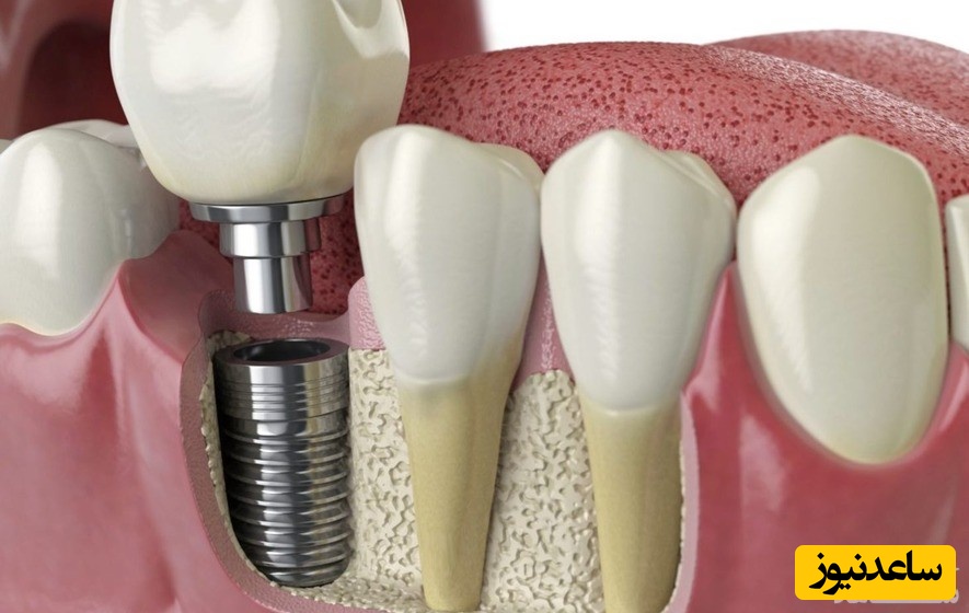 انتخاب بهترین برند ایمپلنت دندان