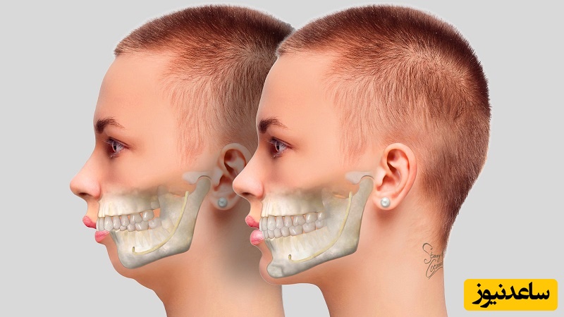 چه فکی را باید جرراحی کرد ؟