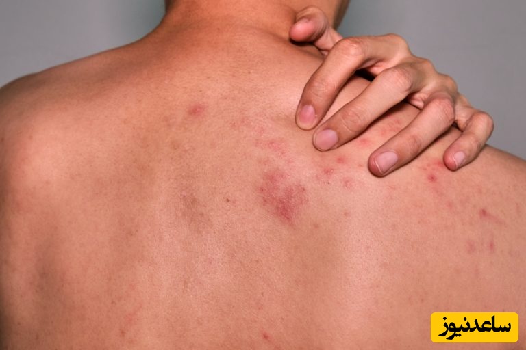 درمان های خانگی برای رفع جوش پشت کمر که باید بدانید