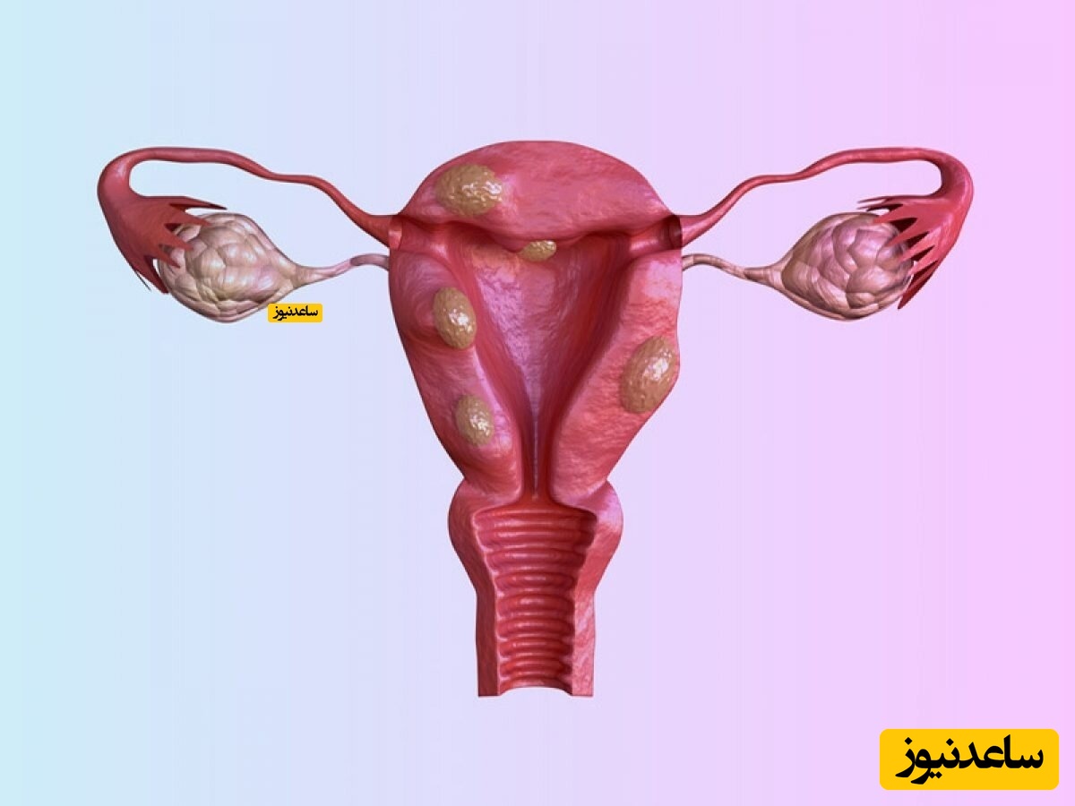 علل و علائم توده ادنکسال در زنان