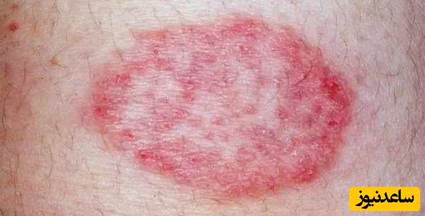 علایم سرطان پوست