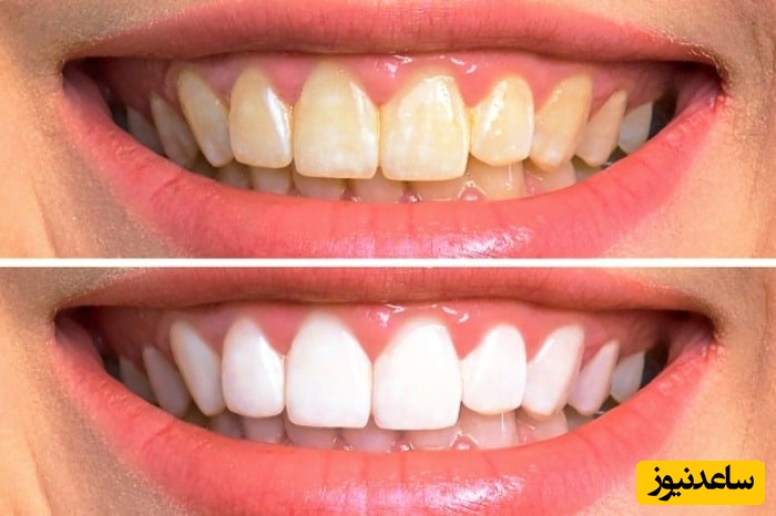 علت زرد شدن دندان ها چیست؟