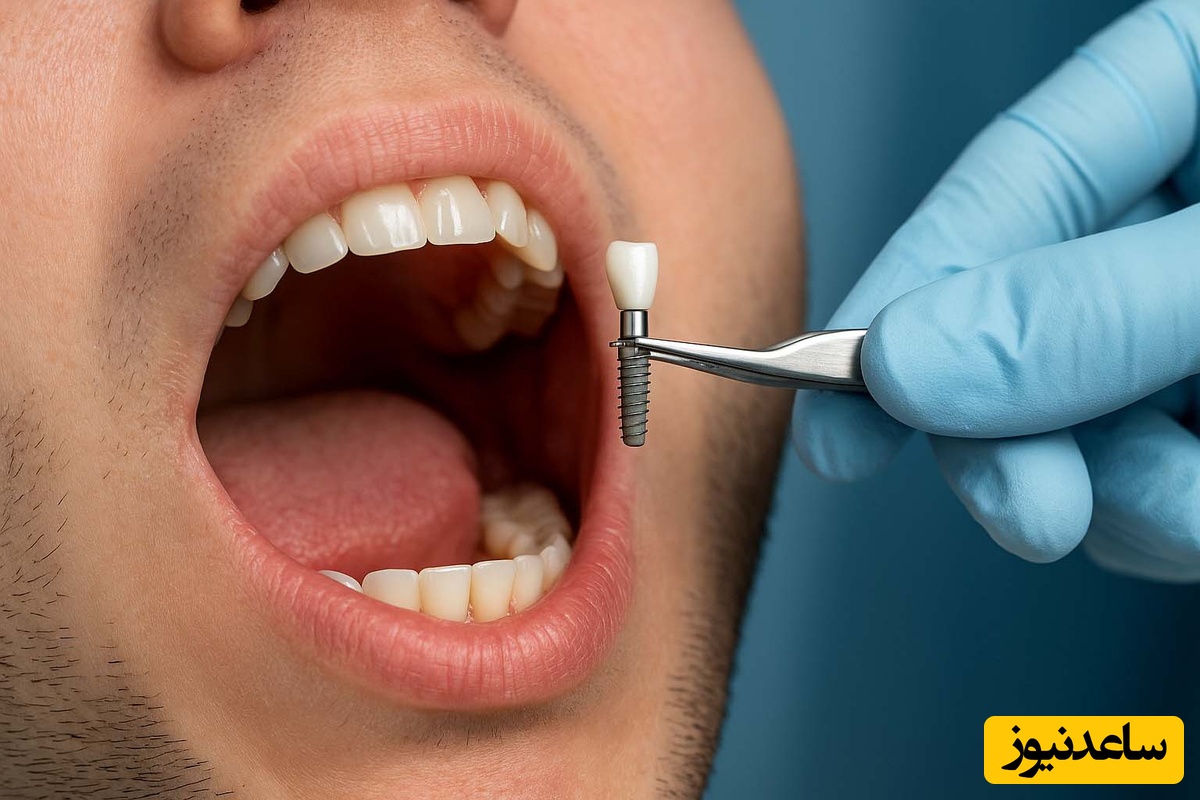 برای جلوگیری از عفونت ایمپلنت دندان چه کار کنیم؟