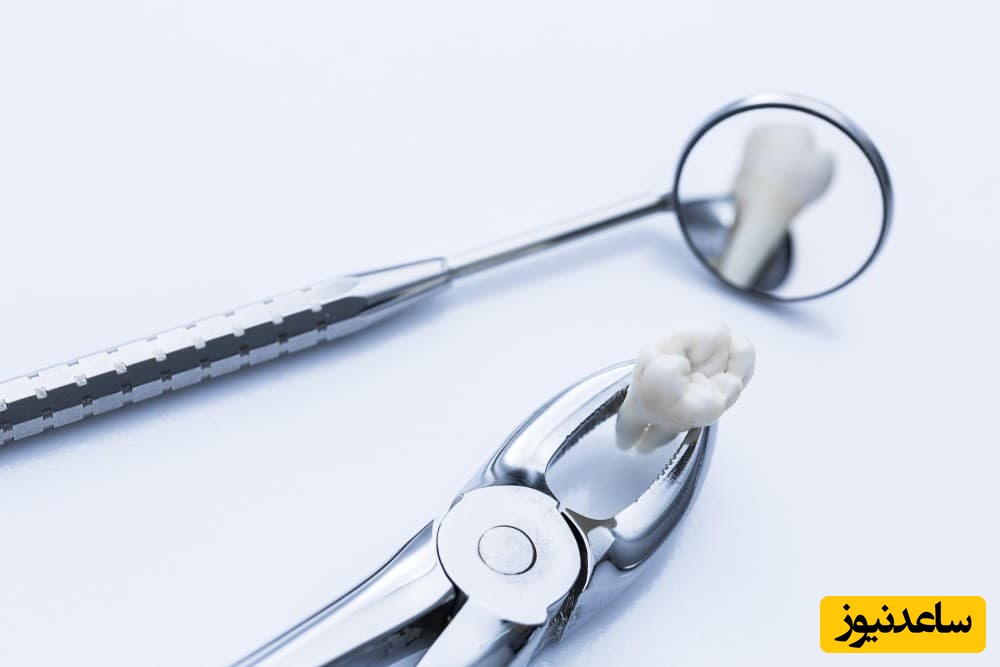 چه زمانی درمورد دندان عقل باید به پزشک مراجعه کنیم؟