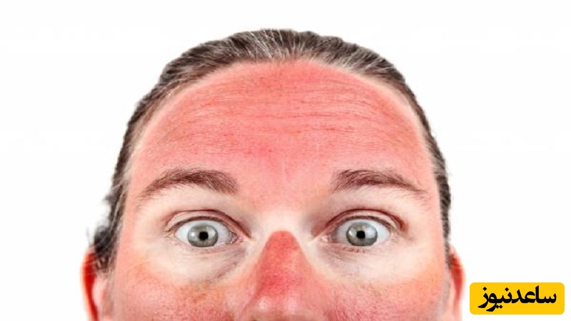 آفتاب سوختگی را جدی بگیرید؛ 11 پماد معجزه‌آسا برای درمان سریع