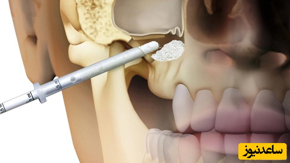 عمل سینوس لیفت دندان چیست؟