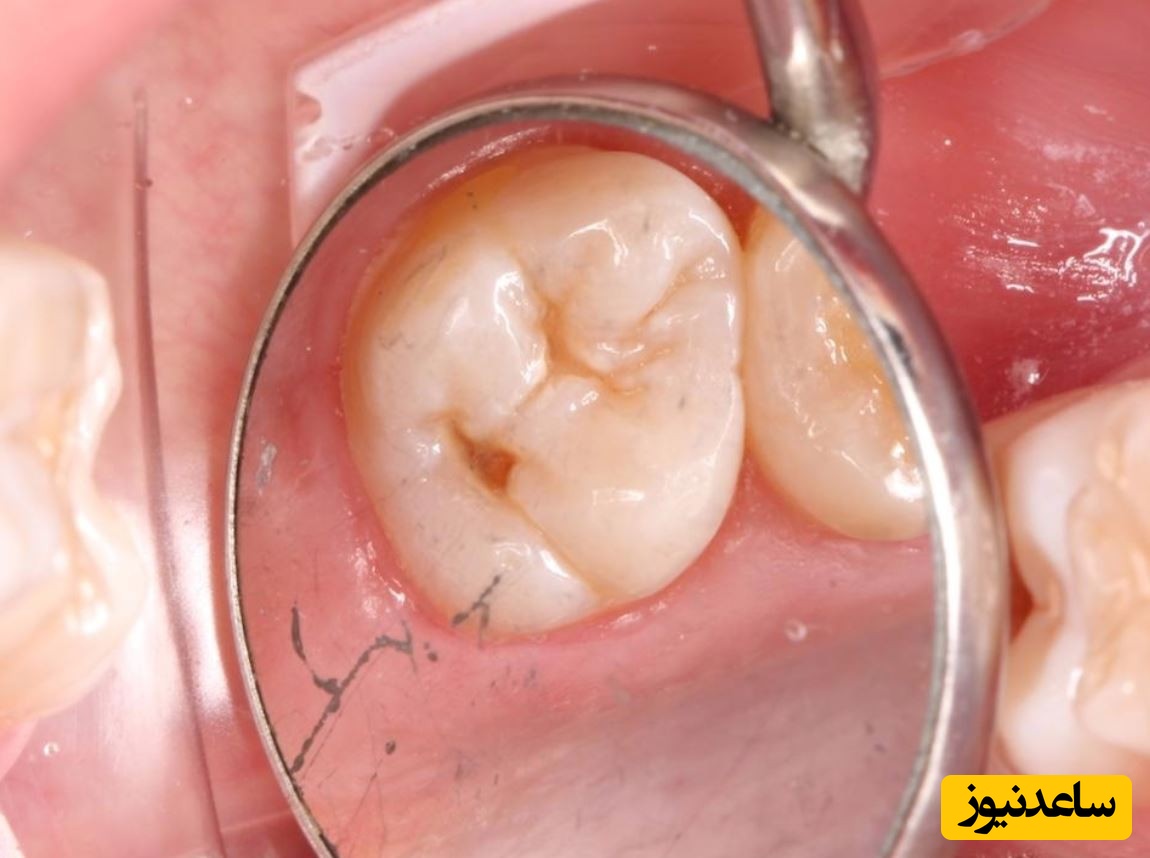 علل بروز حفره های دندانی چیست؟