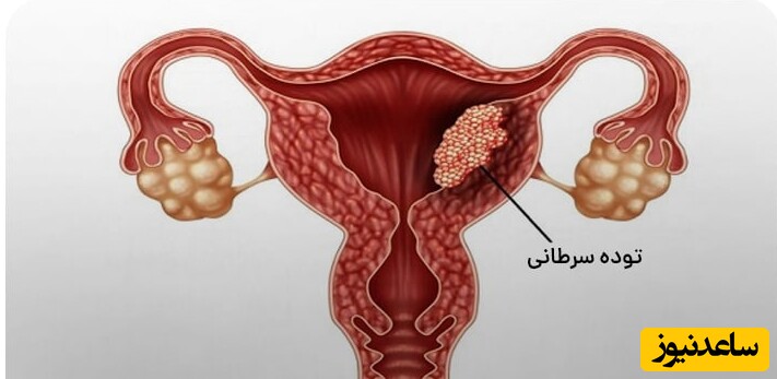 قطع نشدن خونریزی و طولانی شدن پریود چه دلایلی دارد؟