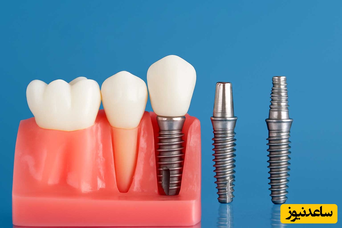 انواع ایمپلنت دندان بر اساس روش کاشت چیست؟