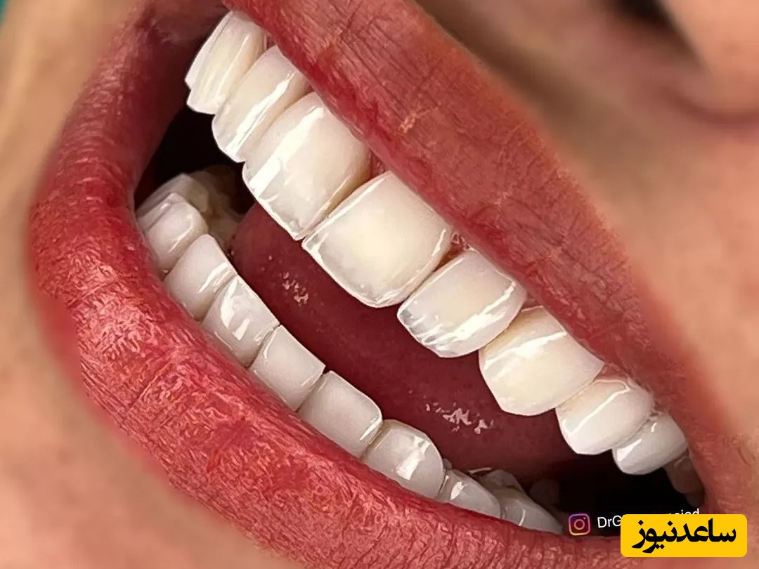 پر تکرار ترین سؤالات درباره لمینت دندان