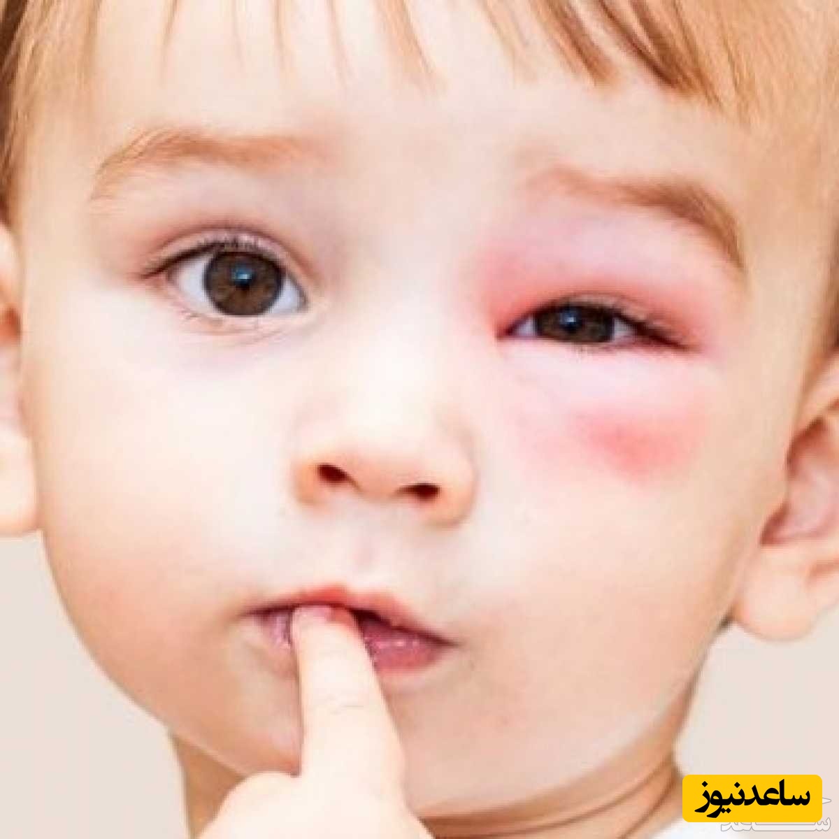 درمان عفونت چشم کودک با روش های خانگی