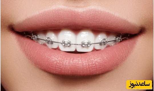 تاثیر ارتودنسی در لاغری صورت امکان پذیر است؟