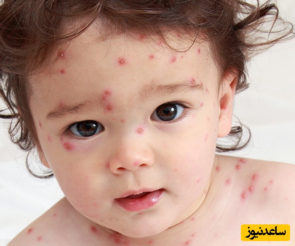 علائم آبله مرغان در کودکان چیست؟ | نشانه‌های اولیه و مراحل پیشرفت بیماری