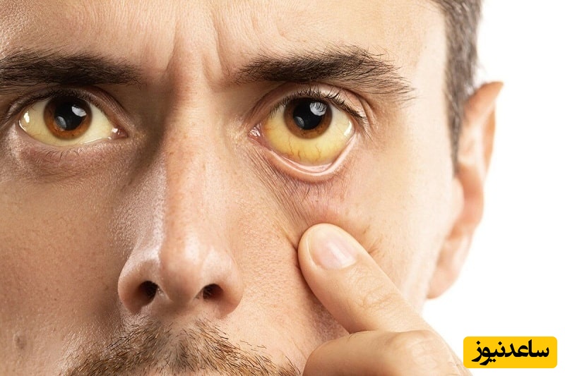 آنچه بیماران هپاتیت C باید درباره این داروی ضدویروس بدانند