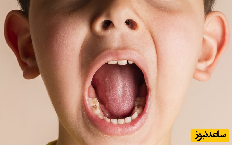 قرمزی لثه در کودکان