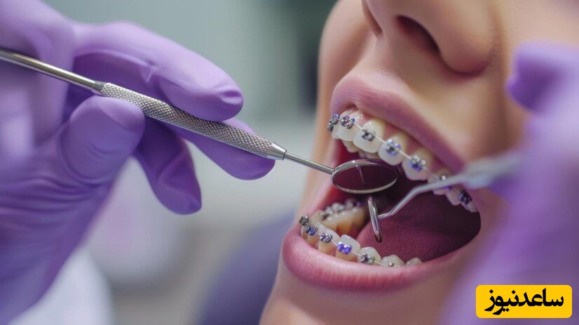 برای جلوگیری از  تورم لثه حین درمان ارتودنسی چه کار کنیم؟