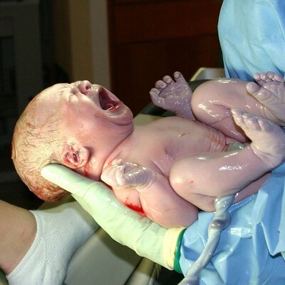 تولد عجیب ترین نوزاد جهان با هاله ای شیشه ای دور سرش+عکس جنین
